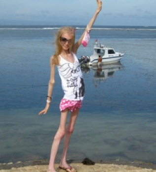 Aos 20 anos e muito magra, anoréxica vira celebridade na Rússia